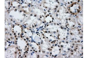 Immunohistochemical staining of paraffin-embedded Carcinoma of liver tissue using anti-IFIT3mouse monoclonal antibody. (IFIT3 antibody)