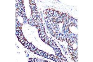 Immunohistochemistry of paraffin-embedded human colon carcinoma using MTCO2 Rabbit mAb (ABIN7266638) at dilution of 1:100 (40x lens). (COX2 antibody)