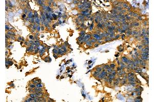 ABIN6263792 and ABIN6277681 at 1/100 staining Human ovarian cancer by IHC-P. (OCA2 antibody  (N-Term))