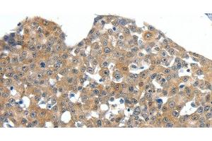 Immunohistochemistry of paraffin-embedded Human esophagus cancer tissue using SCN11A Polyclonal Antibody at dilution 1:40 (SCN11A antibody)