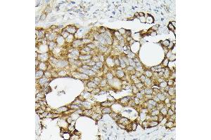 Immunohistochemistry of paraffin-embedded human colon carcinoma using TR antibody (ABIN3023477, ABIN3023478, ABIN3023479 and ABIN6220053) at dilution of 1:50 (40x lens). (TRAF7 antibody)