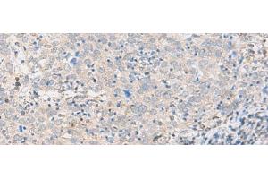 Immunohistochemistry of paraffin-embedded Human cervical cancer tissue using ABHD17B Polyclonal Antibody at dilution of 1:35(x200) (ABHD17B antibody)