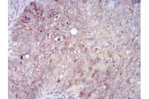 Immunohistochemical analysis of paraffin-embedded cervical cancer tissues using RAB11FIP1 mouse mAb with DAB staining. (RAB11FIP1 antibody  (AA 130-271))