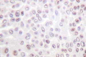 Immunohistochemical analysis of paraffin-embedded human breast cancer tissue using H2BFS polyclonal antibody . (H2BFS antibody)