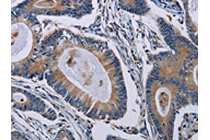 The image on the left is immunohistochemistry of paraffin-embedded Human colon cancer tissue using ABIN7191804(PCDHAC1 Antibody) at dilution 1/50, on the right is treated with synthetic peptide. (PCDHAC1 antibody)