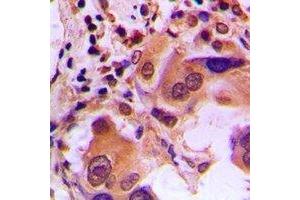 Immunohistochemical analysis of BRCA1 (pS1423) staining in human lung cancer formalin fixed paraffin embedded tissue section. (BRCA1 antibody  (C-Term, pSer1423))