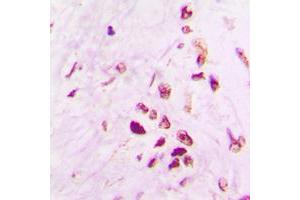 Immunohistochemical analysis of p53 staining in human lung cancer formalin fixed paraffin embedded tissue section.