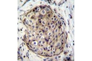 Immunohistochemistry analysis in formalin fixed and paraffin embedded human breast carcinoma reacted with GMP reductase 1 / GMPR1 Antibody (C-term) followed by peroxidase conjugation of the secondary antibody and DAB staining. (GMPR antibody  (C-Term))
