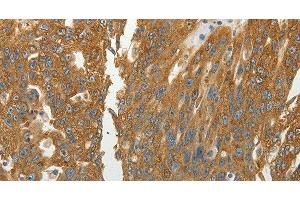 Immunohistochemistry of paraffin-embedded Human ovarian cancer using RPLP0 Polyclonal Antibody at dilution of 1:40 (RPLP0 antibody)