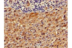 Immunohistochemistry of paraffin-embedded human liver cancer using ABIN7144595 at dilution of 1:100 (ASL antibody  (AA 2-300))