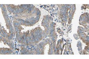 ABIN6274649 at 1/100 staining Human cervical cancer tissue by IHC-P. (CYP2E1 antibody  (Internal Region))