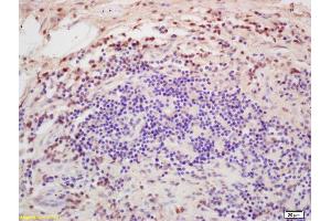 Formalin-fixed and paraffin embedded human colon carcinoma labeled with Rabbit Anti DGAT1/Diglyceride acyltransferase Polyclonal Antibody, Unconjugated (ABIN679568) at 1:200 followed by conjugation to the secondary antibody and DAB staining (DGAT1 antibody  (AA 251-350))