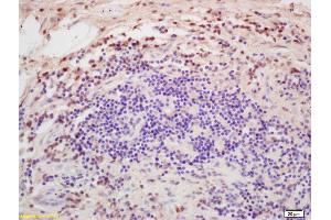Formalin-fixed and paraffin embedded human colon carcinoma labeled with Rabbit Anti DGAT1/Diglyceride acyltransferase Polyclonal Antibody, Unconjugated (ABIN679568) at 1:200 followed by conjugation to the secondary antibody and DAB staining