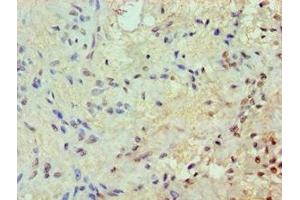 Immunohistochemistry of paraffin-embedded human breast cancer using ABIN7172569 at dilution of 1:100 (JunB antibody  (AA 1-240))