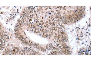 Immunohistochemistry of paraffin-embedded Human colon cancer tissue using TBX2 Polyclonal Antibody at dilution 1:32 (TBX2 antibody)