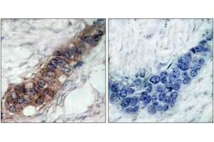 Immunohistochemistry analysis of paraffin-embedded human breast carcinoma tissue, using JAK2 (Ab-221) Antibody. (JAK2 antibody  (AA 191-240))