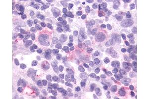Anti-CCR9 antibody IHC of human Lymph Node, Hodgkins Lymphoma. (CCR9 antibody  (Cytoplasmic Domain))