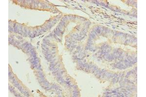 Immunohistochemistry of paraffin-embedded human endometrial cancer using ABIN7161717 at dilution of 1:100 (NRARP antibody  (AA 1-114))