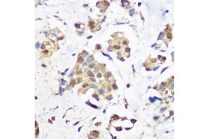 Immunohistochemistry of paraffin-embedded human breast cancer using KDM1 / LSD1 Rabbit mAb (ABIN7268324) at dilution of 1:100 (40x lens). (LSD1 antibody)