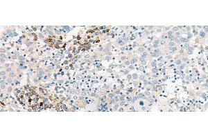 Immunohistochemistry of paraffin-embedded Human cervical cancer tissue using GUCA1B Polyclonal Antibody at dilution of 1:45(x200) (GUCA1B antibody)