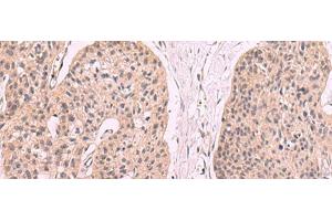 Immunohistochemistry of paraffin-embedded Human esophagus cancer tissue using KLRB1 Polyclonal Antibody at dilution of 1:55(x200) (CD161 antibody)