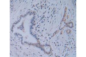 IHC-P analysis of Human Pancreas Cancer Tissue, with DAB staining. (TICAM1 antibody  (AA 443-685))