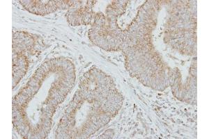 IHC-P Image Immunohistochemical analysis of paraffin-embedded human colon carcinoma, using Factor IX, antibody at 1:250 dilution. (Coagulation Factor IX antibody)