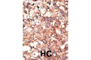 Formalin-fixed and paraffin-embedded human hepatocellular carcinoma tissue reacted with BMP5 polyclonal antibody  , which was peroxidase-conjugated to the secondary antibody, followed by AEC staining.