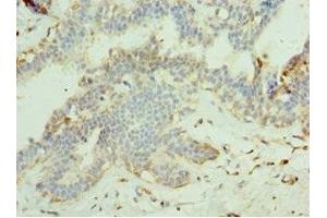 Immunohistochemistry of paraffin-embedded human breast cancer using ABIN7159998 at dilution of 1:100 (MAPK15 antibody  (AA 1-95))