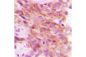 Immunohistochemical analysis of PSMD12 staining in human breast cancer formalin fixed paraffin embedded tissue section. (PSMD12 antibody  (Center))