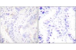 Immunohistochemistry analysis of paraffin-embedded human lung carcinoma tissue, using CrkII (Ab-221) Antibody. (Crk antibody  (AA 187-236))