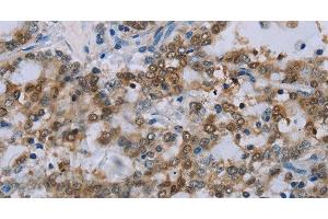 Immunohistochemistry of paraffin-embedded Human liver cancer tissue using MED12 Polyclonal Antibody at dilution 1:40 (MED12 antibody)