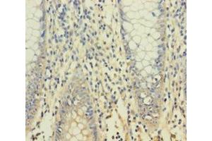Immunohistochemistry of paraffin-embedded human colon cancer using ABIN7166354 at dilution of 1:100 (YPEL1 antibody  (AA 1-119))