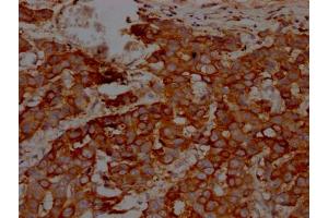 IHC image of ABIN7127566 diluted at 1:100 and staining in paraffin-embedded human breast cancer performed on a Leica BondTM system. (Recombinant IKBKB antibody)