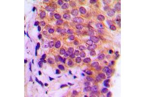 Immunohistochemical analysis of Galectin 9 staining in human breast cancer formalin fixed paraffin embedded tissue section. (Galectin 9 antibody  (Center))
