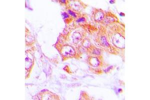 Immunohistochemical analysis of GIT1 staining in human lung cancer formalin fixed paraffin embedded tissue section. (GIT1 antibody  (C-Term))