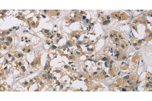 Immunohistochemistry of paraffin-embedded Human thyroid cancer using CYR61 Polyclonal Antibody at dilution of 1:60 (CYR61 antibody)