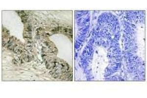 Immunohistochemistry analysis of paraffin-embedded human colon carcinoma tissue using GRB2 (Ab-159) antibody.