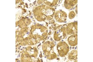 Immunohistochemistry of paraffin-embedded Human gastric using Tp53 antibody at dilution of 1:100 (x400 lens). (p53 antibody)