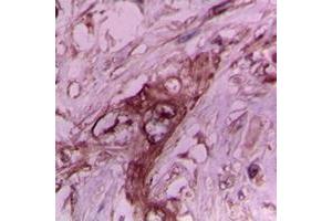 Immunohistochemical analysis of Collagen 2 alpha 1 staining in human breast cancer formalin fixed paraffin embedded tissue section. (COL2A1 antibody  (N-Term))