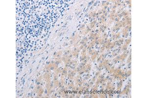 Immunohistochemistry of Human liver cancer using PFN2 Polyclonal Antibody at dilution of 1:30