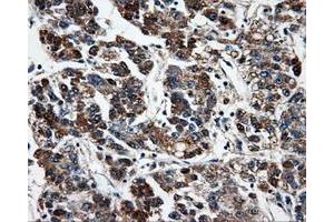 Immunohistochemical staining of paraffin-embedded Carcinoma of liver tissue using anti-FAHD2Amouse monoclonal antibody.