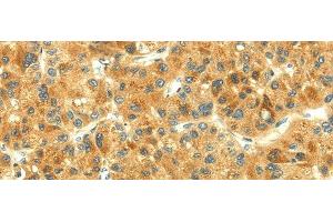 Immunohistochemistry of paraffin-embedded Human liver cancer using THAP3 Polyclonal Antibody at dilution of 1/30 (THAP3 antibody)