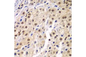 Immunohistochemistry of paraffin-embedded human liver cancer using SF3B2 antibody (ABIN5973482) at dilution of 1/100 (40x lens). (SF3B2 antibody)
