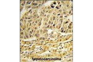 Formalin-fixed and paraffin-embedded human hepatocarcinoma reacted with CCNB1IP1 Antibody (C-term) , which was peroxidase-conjugated to the secondary antibody, followed by DAB staining. (CCNB1IP1 antibody  (C-Term))