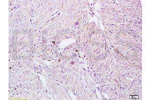 Formalin-fixed and paraffin embedded human breast carcinoma tissue labeled with Anti-CD161 Polyclonal Antibody, Unconjugated (ABIN680998) at 1:200 followed by conjugation to the secondary antibody and DAB staining (CD161 antibody  (AA 151-225))