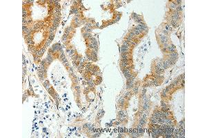 Immunohistochemistry of Human thyroid cancer using SELM Polyclonal Antibody at dilution of 1:50