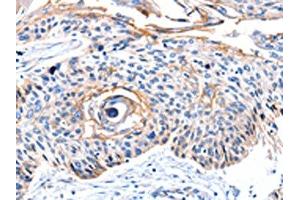 The image on the left is immunohistochemistry of paraffin-embedded Human esophagus cancer tissue using ABIN7190097(CCNB2 Antibody) at dilution 1/10, on the right is treated with synthetic peptide. (Cyclin B2 antibody)