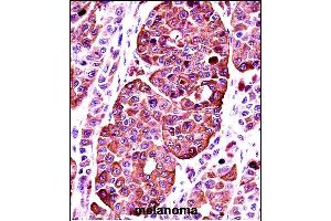 TYR Antibody (Center) ((ABIN391521 and ABIN2841481))immunohistochemistry analysis in formalin fixed and paraffin embedded human melanoma followed by peroxidase conjugation of the secondary antibody and DAB staining. (TYR antibody  (AA 176-205))
