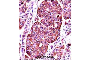 TYR Antibody (Center) ((ABIN391521 and ABIN2841481))immunohistochemistry analysis in formalin fixed and paraffin embedded human melanoma followed by peroxidase conjugation of the secondary antibody and DAB staining. (TYR antibody  (AA 176-205))